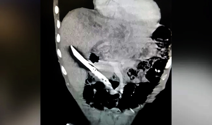 गांजा नहीं मिला तो निगल गया चाकू, X-Ray देखकर डॉक्टर के भी उड़े होश