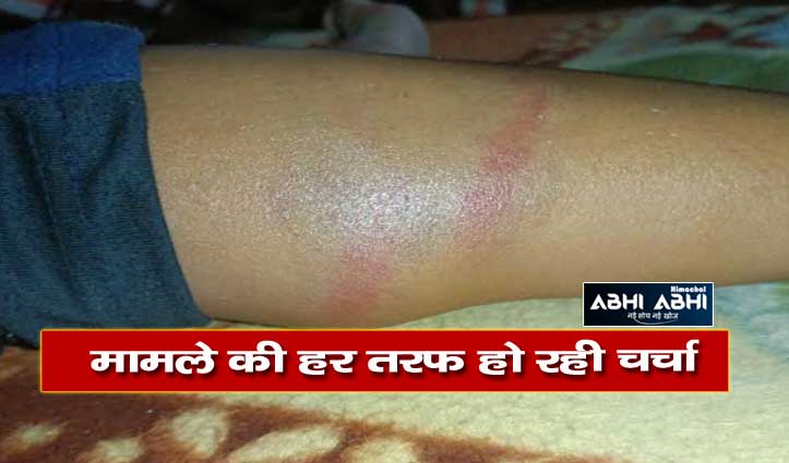 ऊना के प्राइमरी स्कूल में शिक्षिका ने पीटा छात्र, शरीर पर उभर आए डंडे के निशान