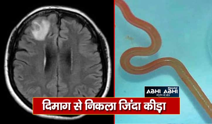 a-live-roundworm-detected-in-women-brain-first-time-in-the-world